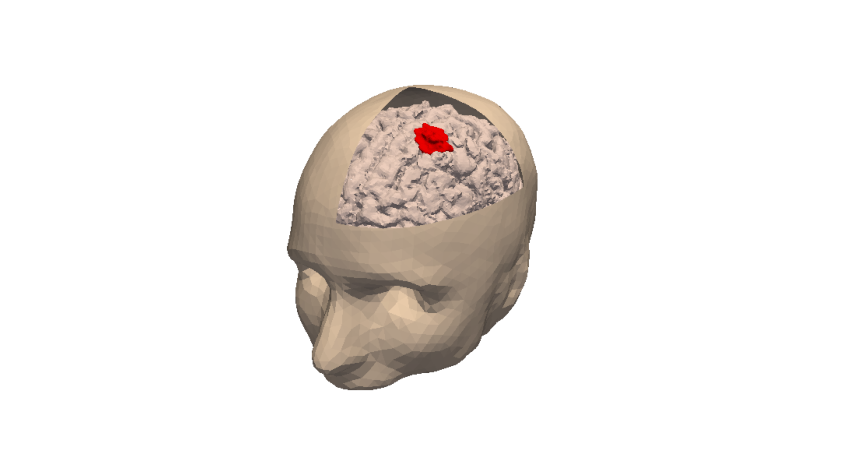 3D numerical simulation of a meningioma. The tumor is shown in red.