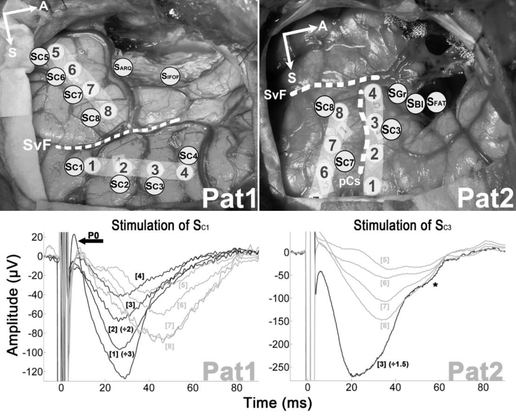 Positioning of ECoG bands and stimulation sites with local and remote evoked (delayed and attenuated) responses