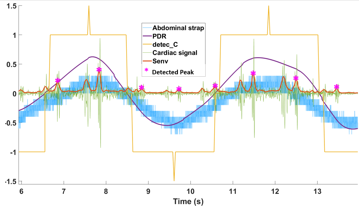 PCG signal processing with classical S1 S2 cardiac sounds and PDR enveloppe that reflects respiratory cycles.