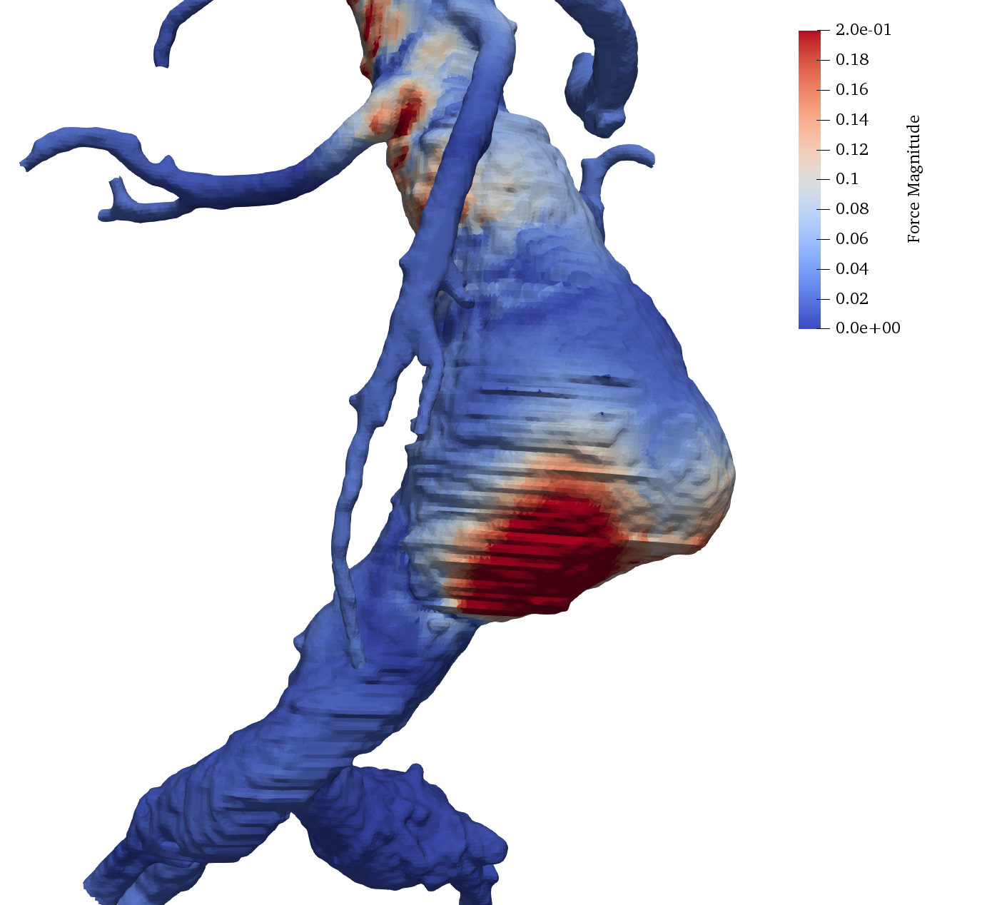 force distribution on the walls of the abdominal aorta in presence of an aneurysm.