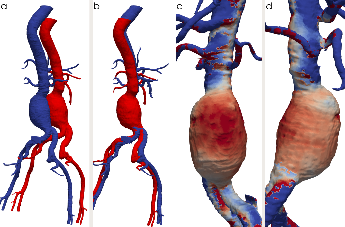Example of registration. a and b: CT scans (blue: first CT scan; red: second CT scan) before and after registration. c and d: visualization of the evolution after registration. The aneurysm shrunk on the blue parts and grew on the red parts.