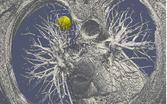 3D numerical simulation of a lung tumor. The tumor is shown in yellow.