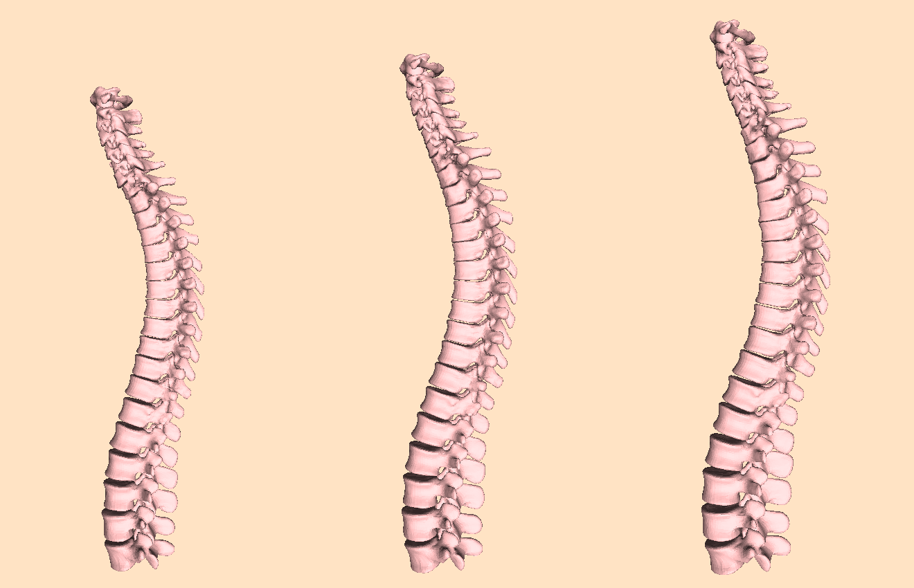 The spine model is a graphical model mesh architecture parametrized by the shape parameters and the pose parameters, where each vertebrae has its own translation and rotation. The first shape parameter is show, which accounts for the global size of the spine.