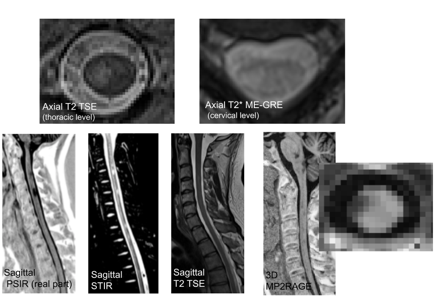Prognostic value of spinal cord MRI in multiple sclerosis patients: Illustrations of spinal cord MRI sequences available in our studies. This illustrates the diversity of signals and resolutions resulting from the variety of available sequences.