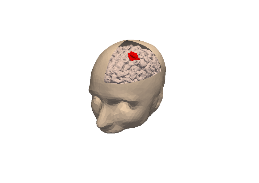 3D numerical simulation of a meningioma.