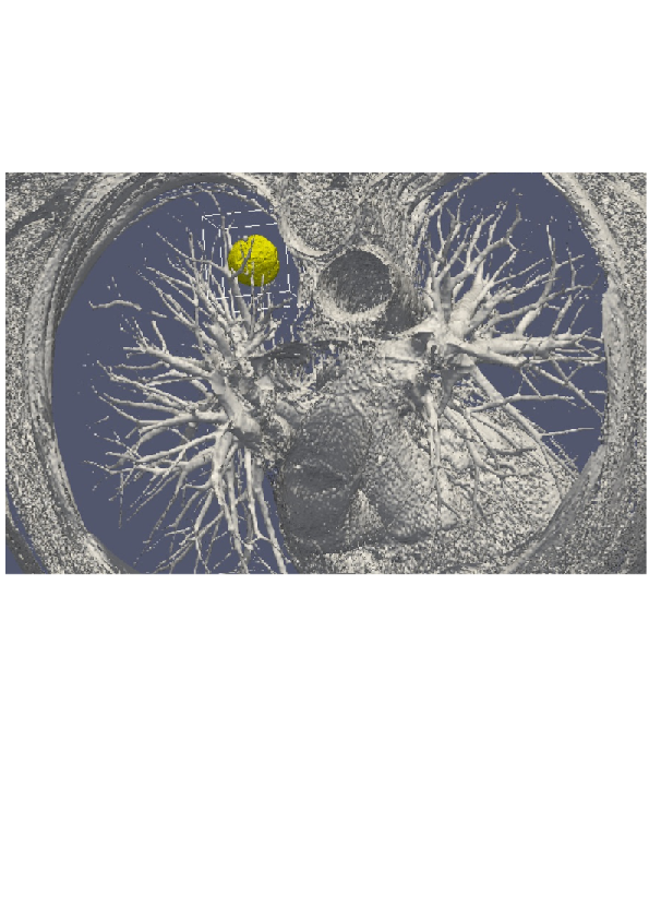 3D numerical simulation of a lung tumor.