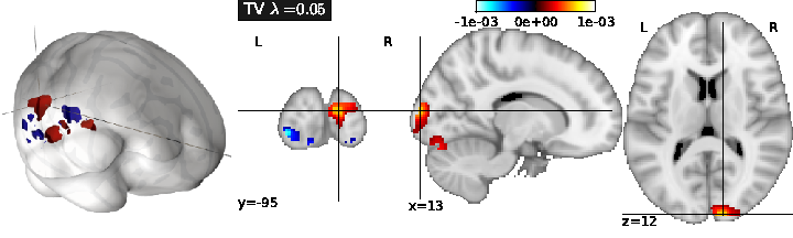 Example of the regularization of a brain map with total
variation in an inverse problem. The problem here is to
predict the spatial scale of an object presented as a stimulus,
given functional neuroimaging data acquired during the presentation
of an image. Learning and test are performed across
individuals. Unlike other approaches, Total Variation regularization
yields a sparse and well-localized solution that also enjoys high
predictive accuracy.
