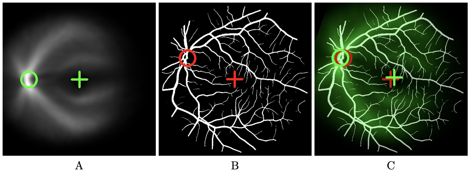 This figures illustrates how our method to detect the fovea works. It contains three images. The left image shows the vessel density map. This map is obtained by realigning and then averaging a set of vessel maps for which fovea and optic disk position are known. The are realigned based upon fixed positions of fovea and optic disk which are marked by a green cross and a green circle respectively. The middle image shows the vessel map where the fovea position is unknown. In our example, the ground truth is available allowing error estimates. Red cross indicates the true position of the fovea we are looking for. The right image shows the vessel density map in green-scale color superimposed on the vessels map after registration. The fovea position of the vessel density map after registration serves as an estimate for the fovea position. It is represented by a green cross. When ground truth is available (red cross), error can be estimated (distance between green and red crosses).