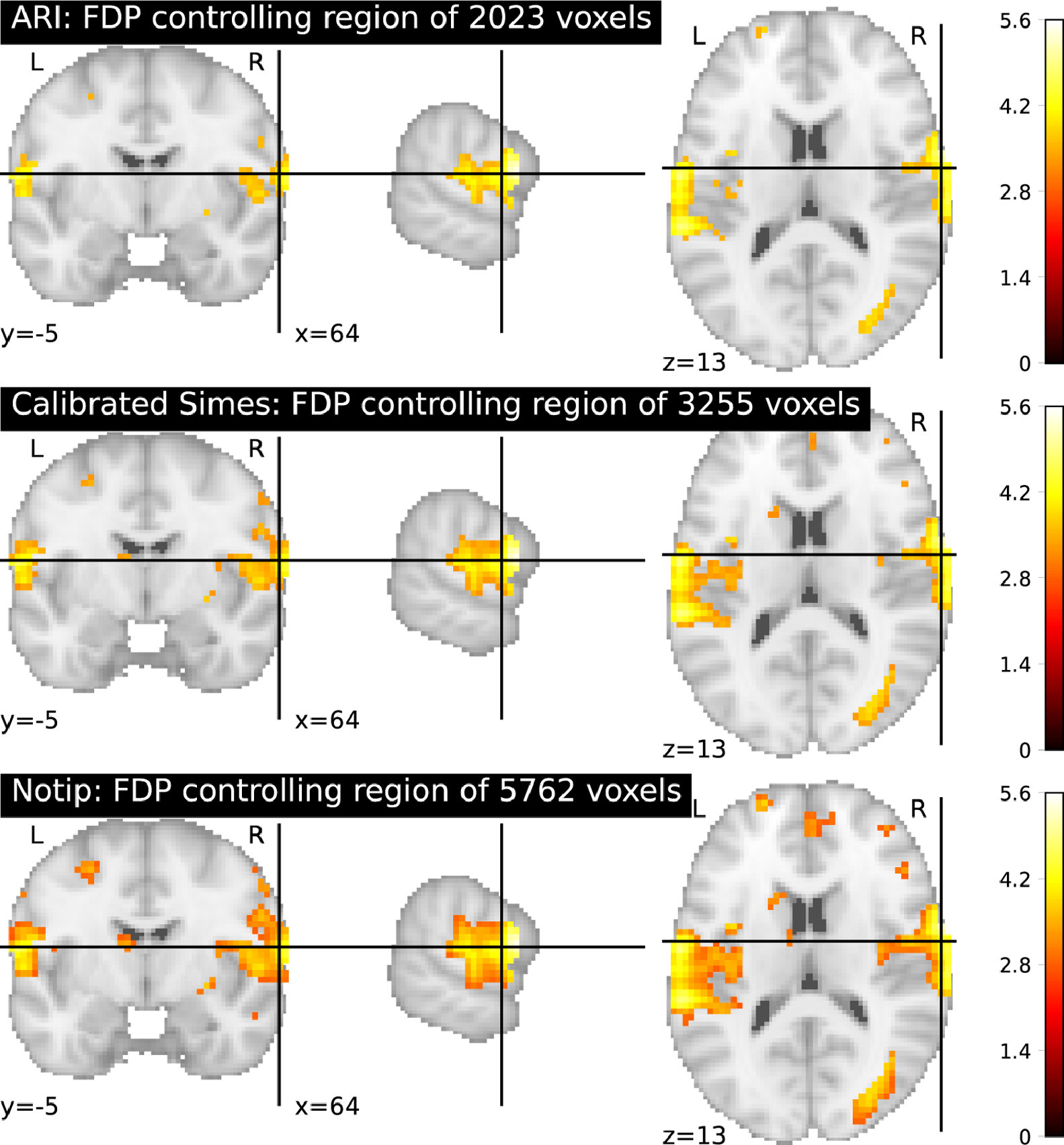 Comparison of the number of detections between ARI, calibrated Simes and learned template on fMRI data. Considering brain activity difference for a pair of functional Magnetic Renance Imaging contrasts ”look negative cue” vs ”look negative rating”, we compute the largest possible region such that False Discovery Proportion is controled, for the three possible templates: All-resolution inference, calibrated Simes template and learned template (our solution). Notice that the number of detections is markedly higher (+ 77%) using the learned template compared to the calibrated Simes template, and almost three times that of all-resolution inference procedure.