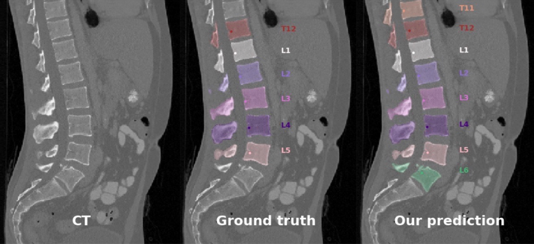 Given a 3D CT as input, the spine is segmented into individual vertebrae. We leverage anatomical constraints together with deep networks for their localization and segmentation. Once the location is stable, its identification is obtained from its segmentation. The set of location, segmentation and identification is cycled through until the consistency criteria are met. Our method accounts for the pathologic vertebrae, such as L6, T13 or the lack of T12.
